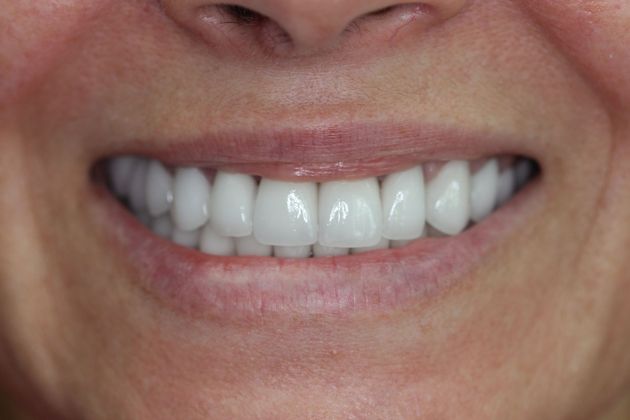 Case 1 after full mouth reconstruction procedure